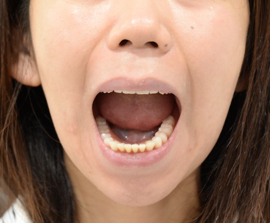 自分の歯と一緒と思える総入れ歯 30歳女性 治療から1ヶ月を迎えて 東京都千代田区 稲葉歯科医院 総入れ歯専門サイト