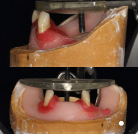 下顎の歯は犬歯から並べていきます1
