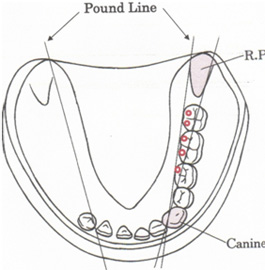 下顎の歯は犬歯から並べていきます2